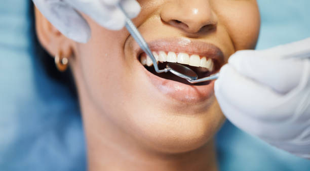 Best Emergency Wisdom Tooth Extraction in Huntgton, IN